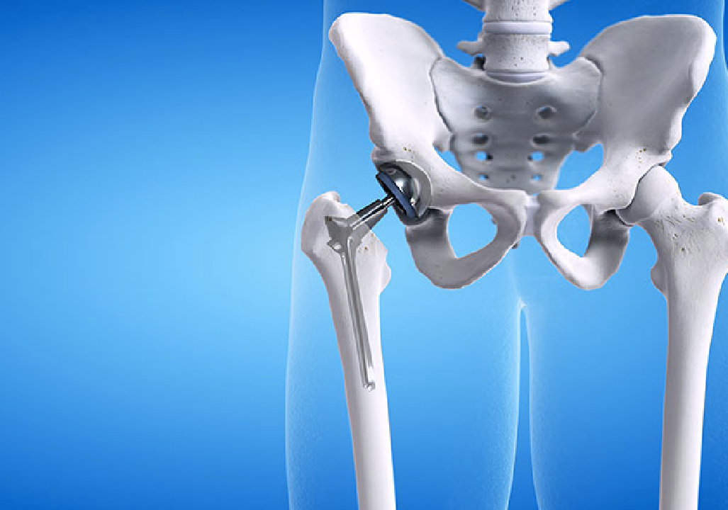 Hip Replacement In Pune